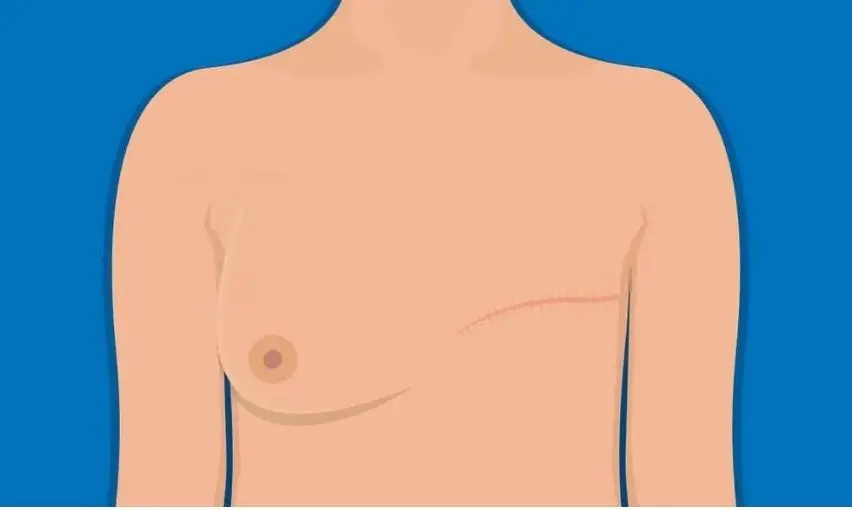 عملية تجميل الثدي بعد الاستئصال